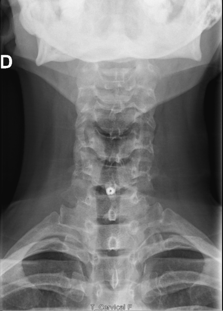 Radiographie de face du rachis cervical après arthrodèse cervicale