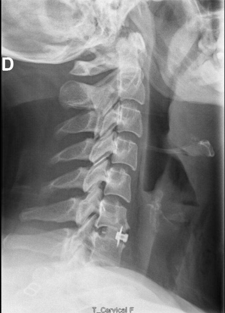 Radiographie de profil du rachis cervical après arthrodèse cervicale