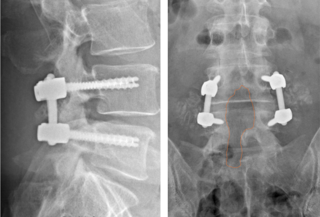 Radiographies de profil et de face après arthrodèse lombaire L4-L5 par vis et tiges
