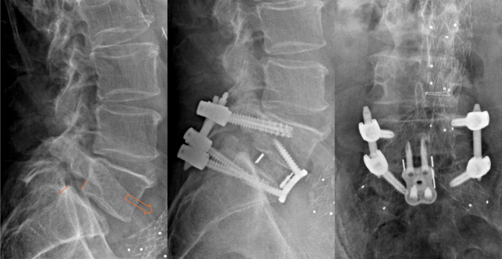 Radiographies avant et après arthrodèse circonférentielle L5-S1 par cage antérieure, vis et tiges