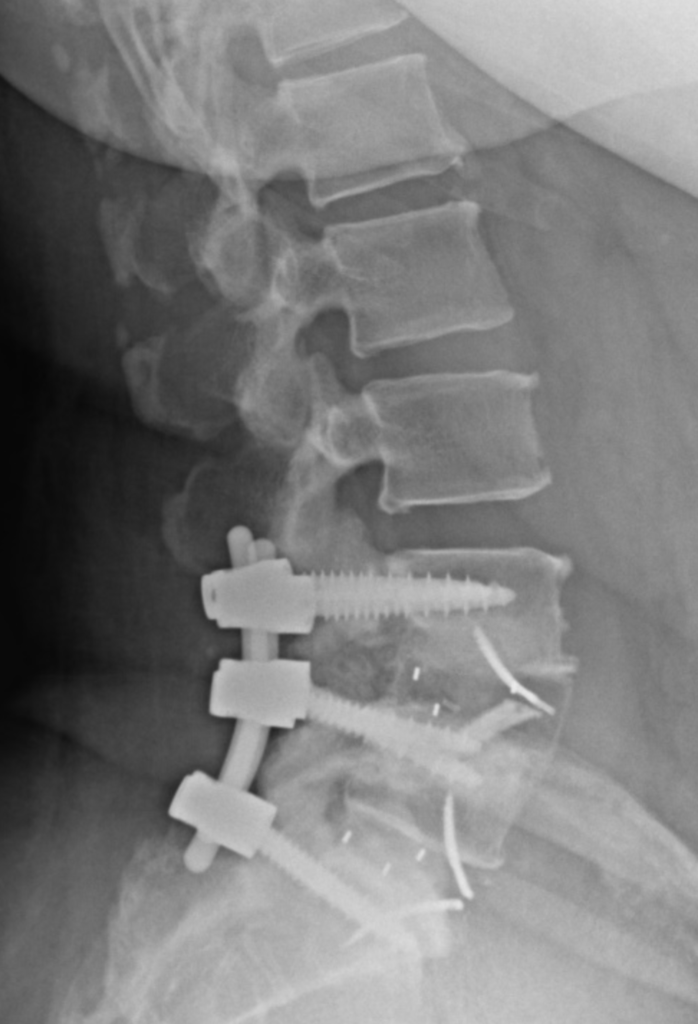 Radiographie lombaire de profil après arthrodèse lombaire par vis, tiges et cage