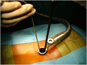 Tube de rétraction MetrX en place pendant une chirurgie mini-invasive du rachis