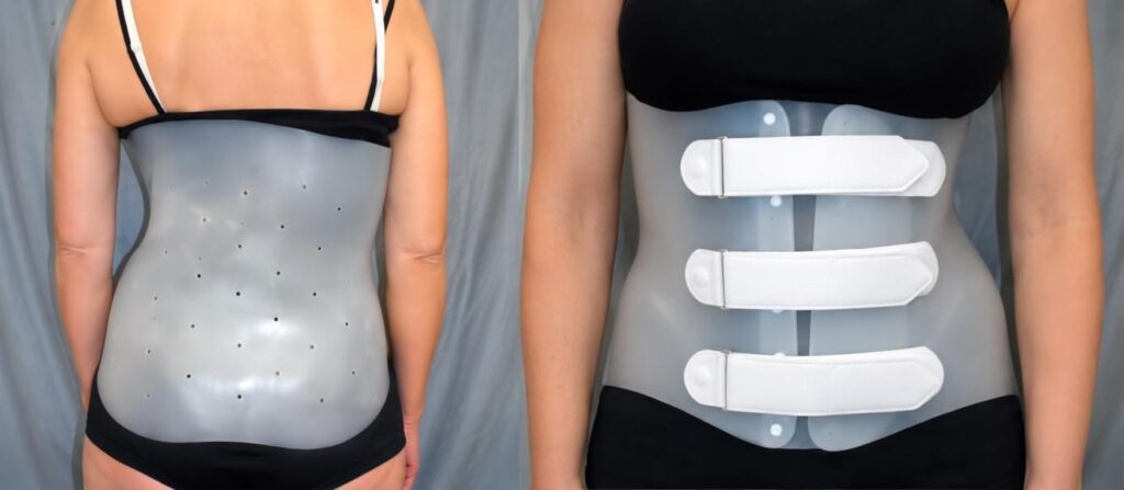 Corset lombaire thermoformé pour scoliose de l’adulte, vu de dos et de face