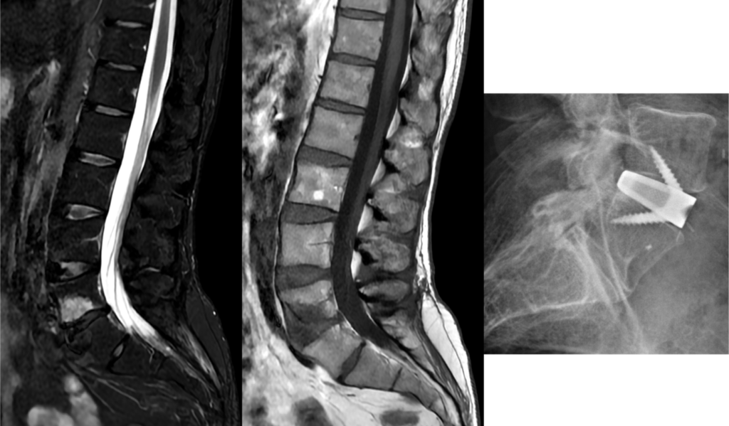 IRM lombaire d’une discopathie Modic 1, puis radiographie après arthrodèse par cage