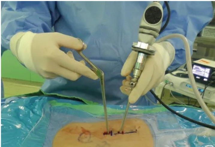 Endoscopie biportale (UBE) : endoscope et instrument introduits par deux incisions