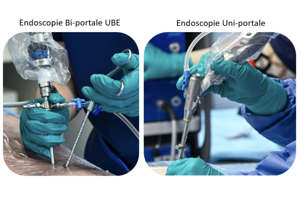 Endoscopie du rachis pendant l’intervention : technique biportale (UBE) et technique uniportale