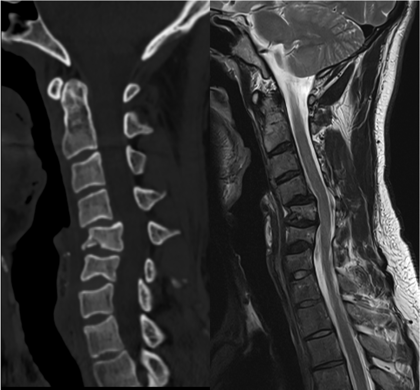 Les fractures du rachis cervical