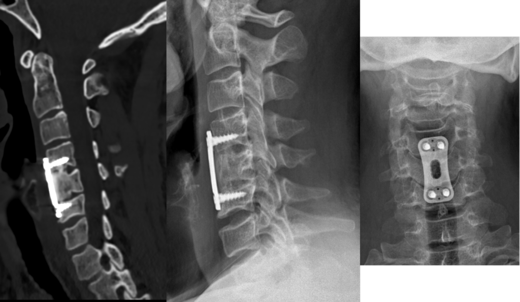 Scanner et radiographies après stabilisation chirurgicale d’une fracture cervicale par cage et plaque
