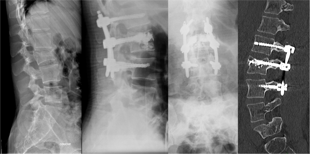 Radiographies et scanner après ostéosynthèse postérieure par vis et tiges d’une fracture vertébrale