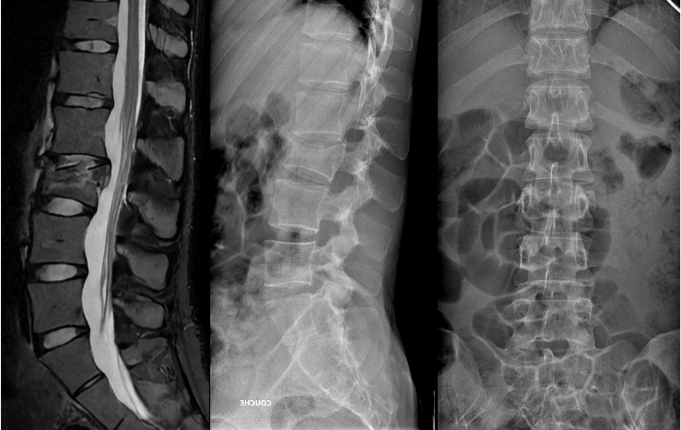 Les fractures du rachis thoraco-lombaire
