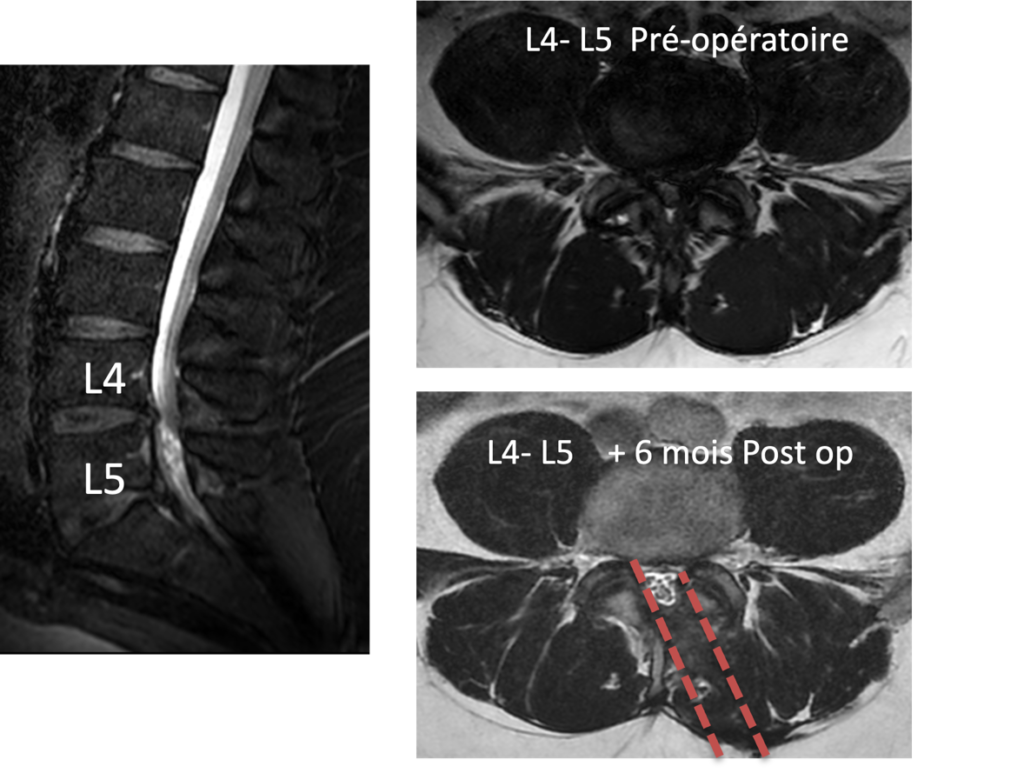 IRM L4-L5 avant et six mois après une décompression mini-invasive d’un canal lombaire étroit