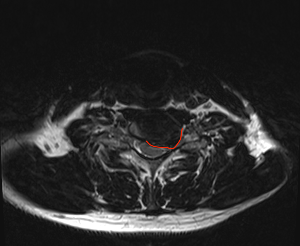 IRM cervicale en coupe axiale montrant une hernie discale cervicale