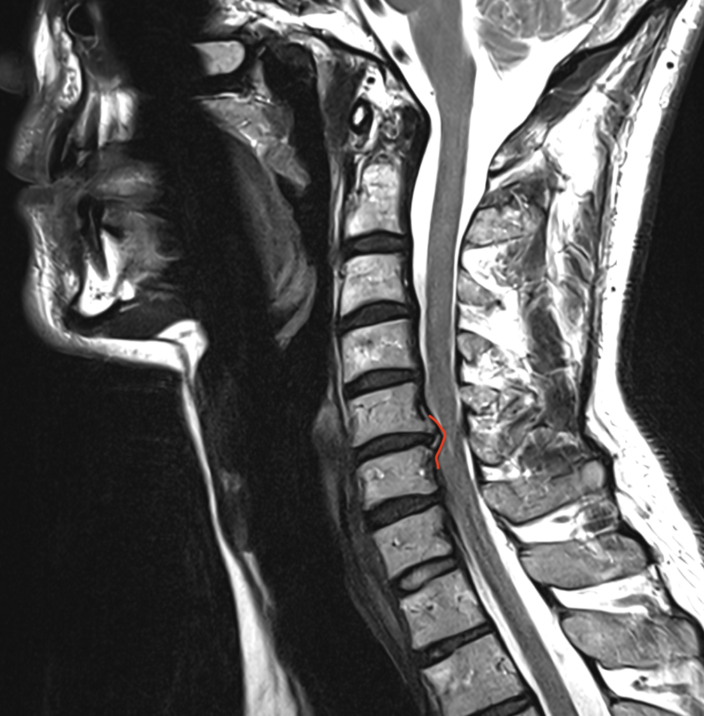 IRM cervicale en coupe sagittale montrant une hernie discale cervicale