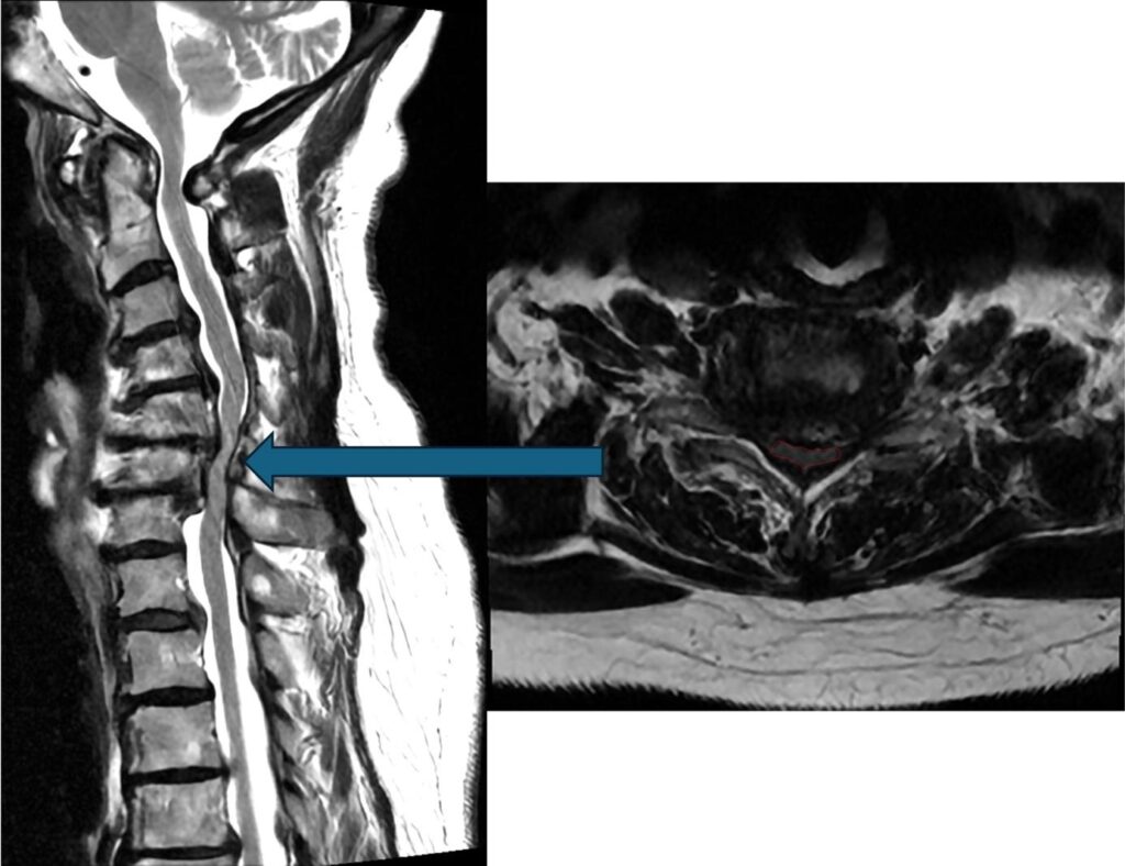 IRM cervicale en coupes sagittale et axiale montrant une compression de la moelle épinière (myélopathie cervicale)