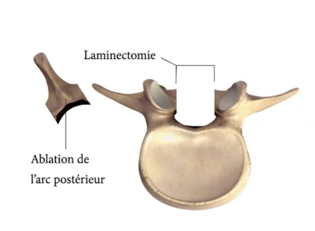 Schéma d’une laminectomie lombaire : ablation de l’arc postérieur de la vertèbre pour libérer le canal