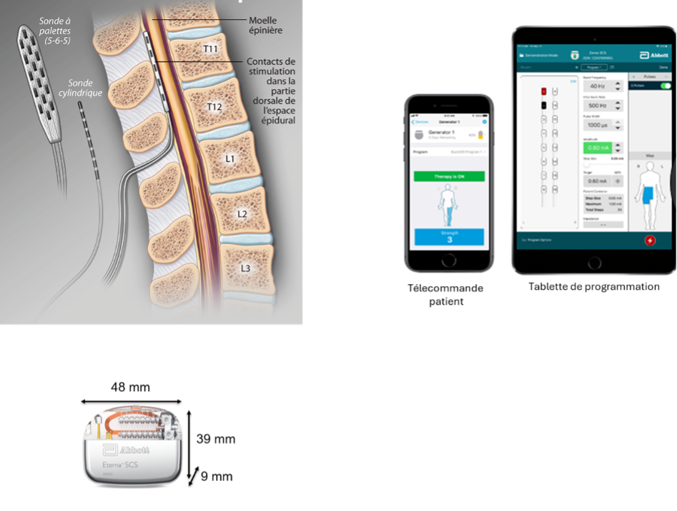 Neurostimulation médullaire : électrodes dans l’espace épidural, neurostimulateur implantable et télécommande