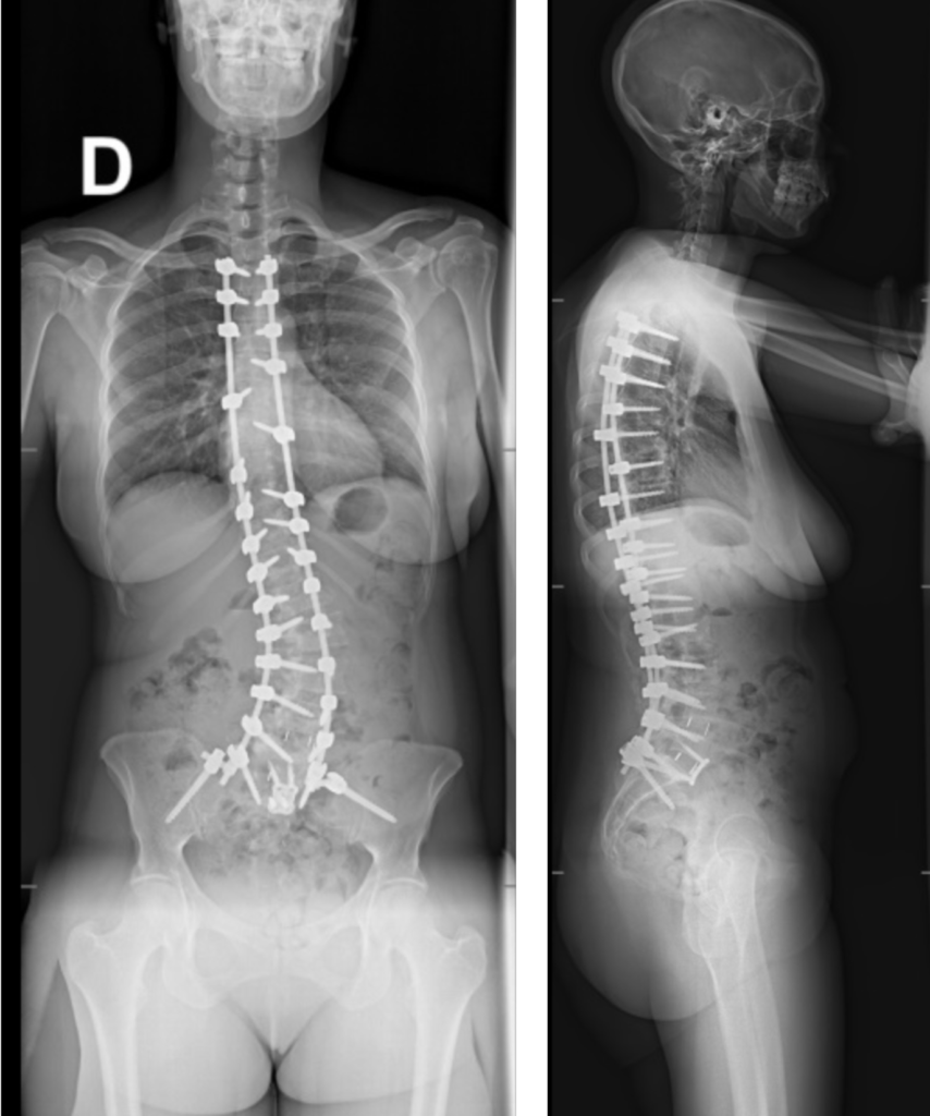 Radiographies de face et de profil après opération d’une scoliose de l’adulte par arthrodèse étendue