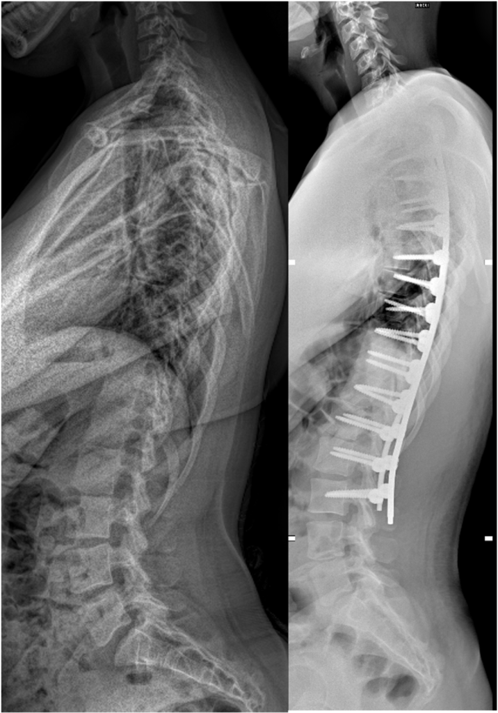 Radiographies de profil avant et après opération de la scoliose par arthrodèse vertébrale postérieure