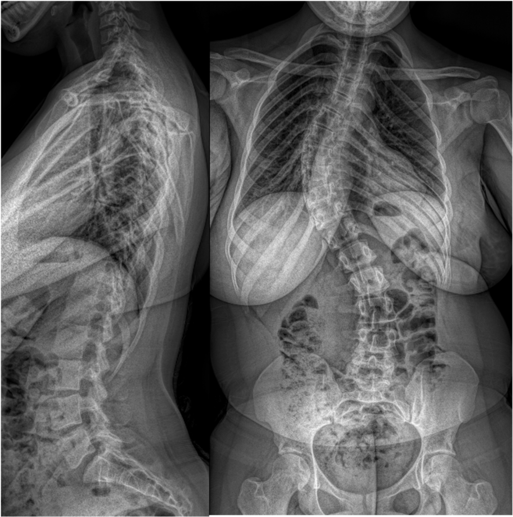 Radiographies de face et de profil d’une scoliose idiopathique de l’adolescent