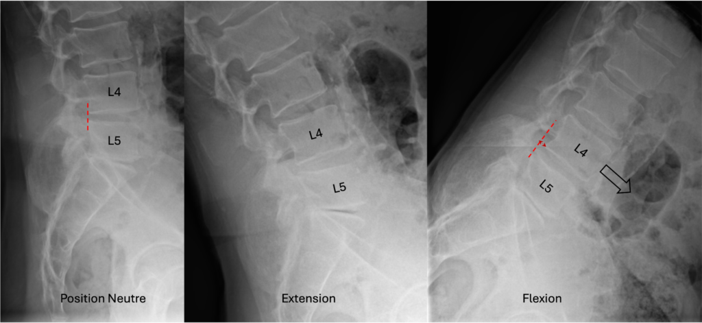 Radiographies lombaires dynamiques de profil (neutre, extension, flexion) montrant le spondylolisthésis L4-L5