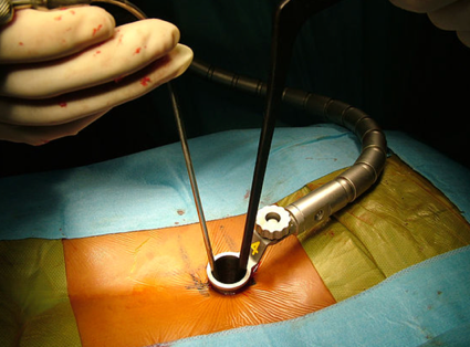 Tube de rétraction fixé au bras articulé pendant une chirurgie mini-invasive